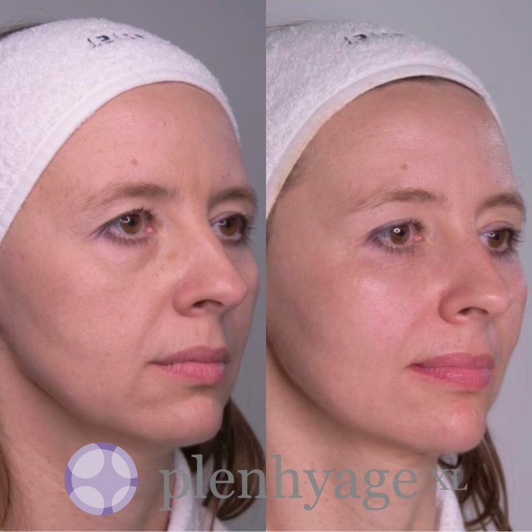 Stymulator tkankowy twarzy oraz szyi